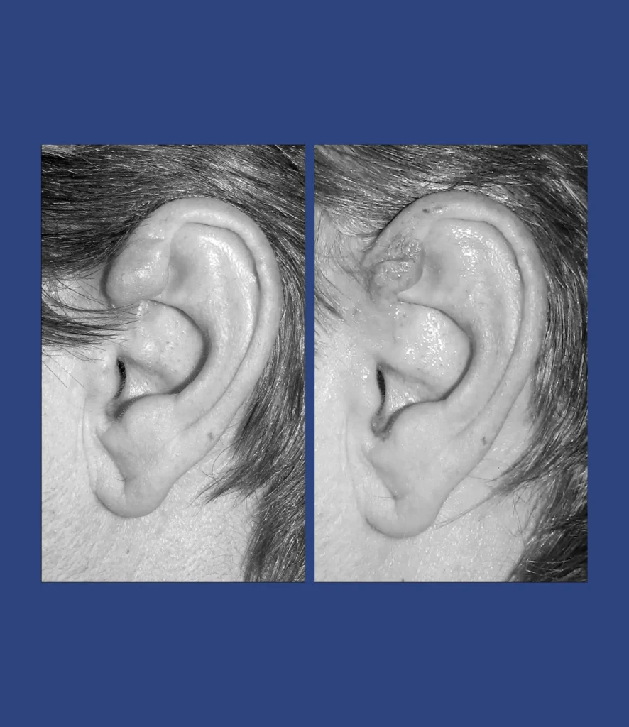Otoplastica Dott. Di Mascio - Cheloide monolaterale | Caso 13 - Foto 1