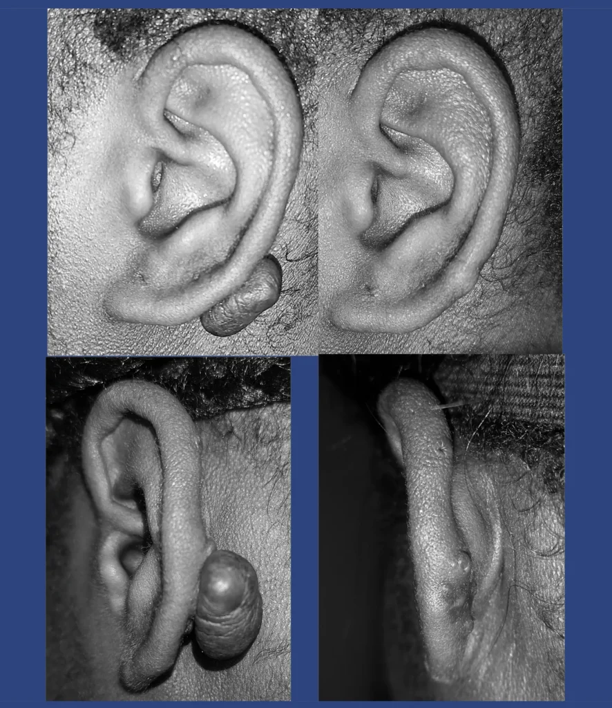 Otoplastica Dott. Di Mascio - Cheloidi | Caso1 - Foto 2