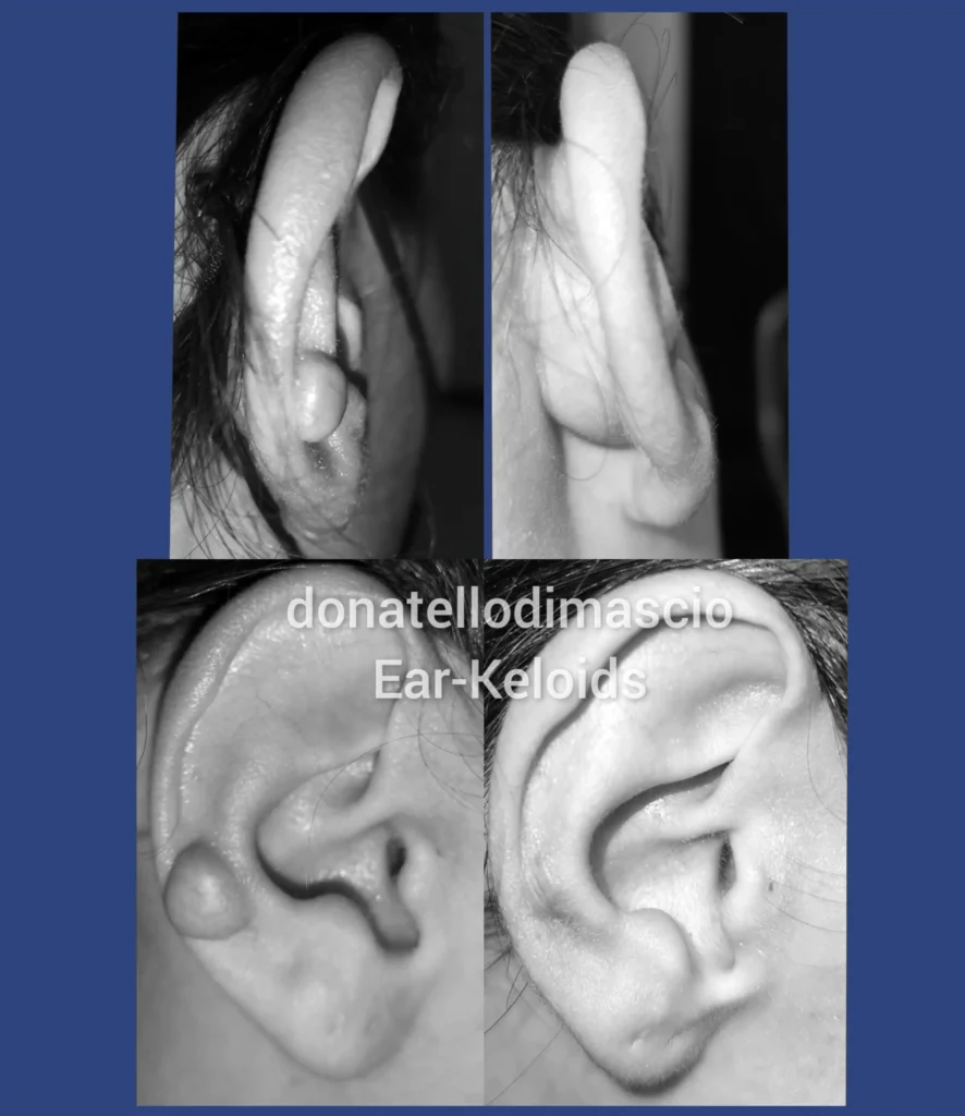 Otoplastica Dott. Di Mascio - Cheloidi monolaterali | Caso2 - Foto 1