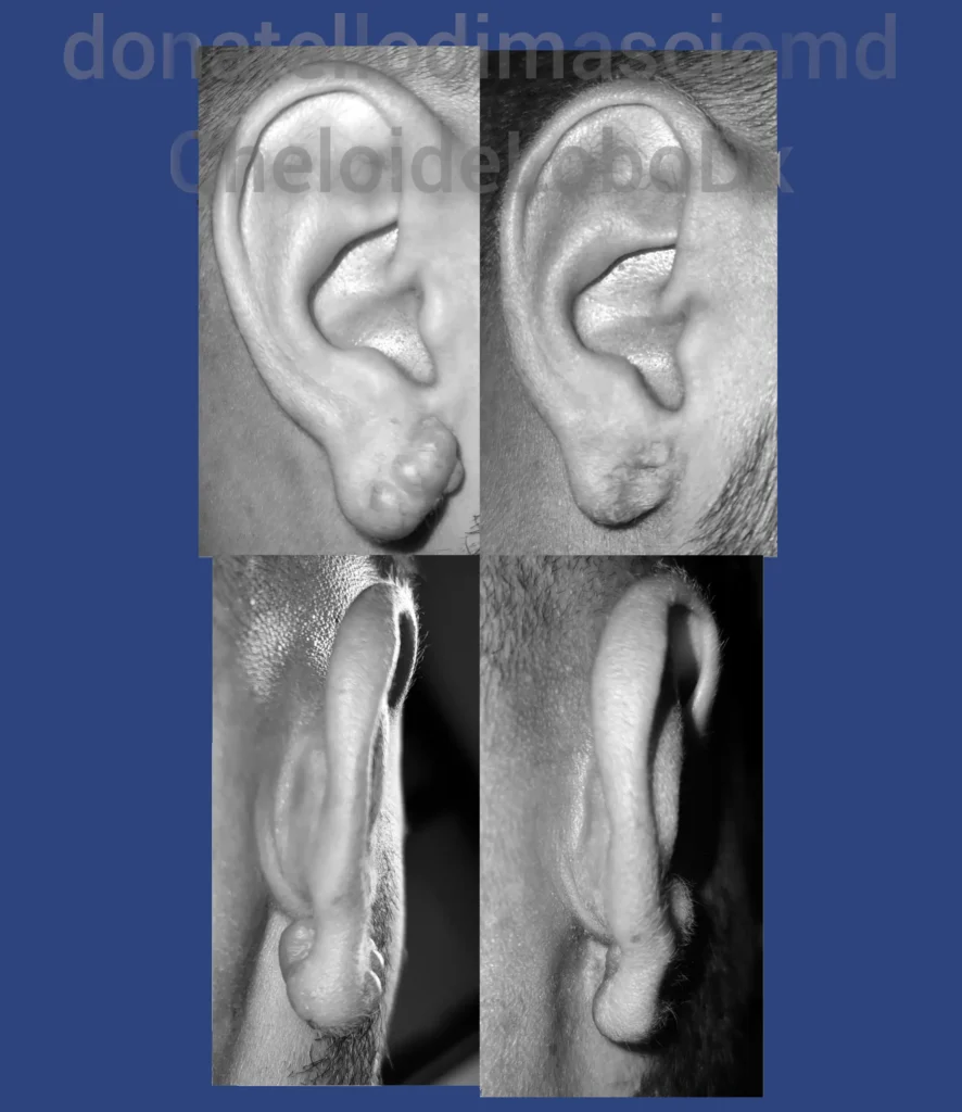 Otoplastica Dott. Di Mascio - Cheloide Lobo destro | Caso 3 - Foto 1