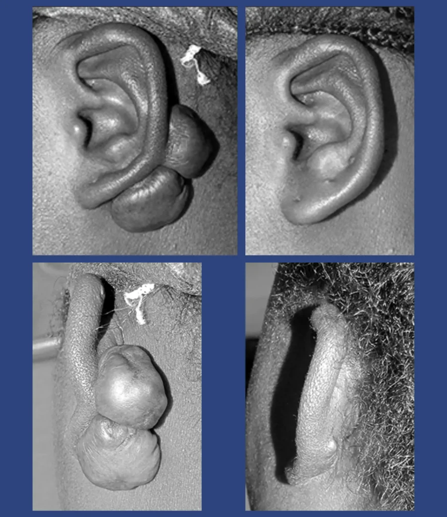 Otoplastica Dott. Di Mascio - Cheloidi | Caso 5 - Foto 1