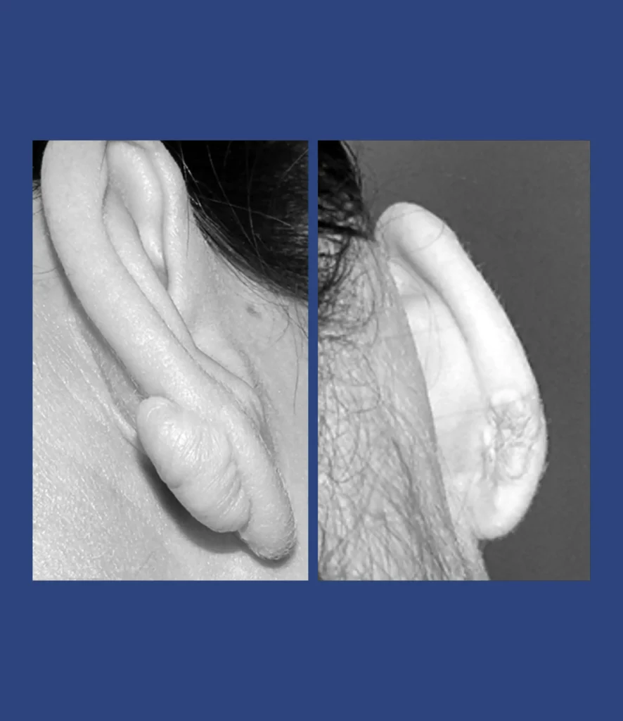 Otoplastica Dott. Di Mascio - Cheloide monolaterale | Caso 7 - Foto 1