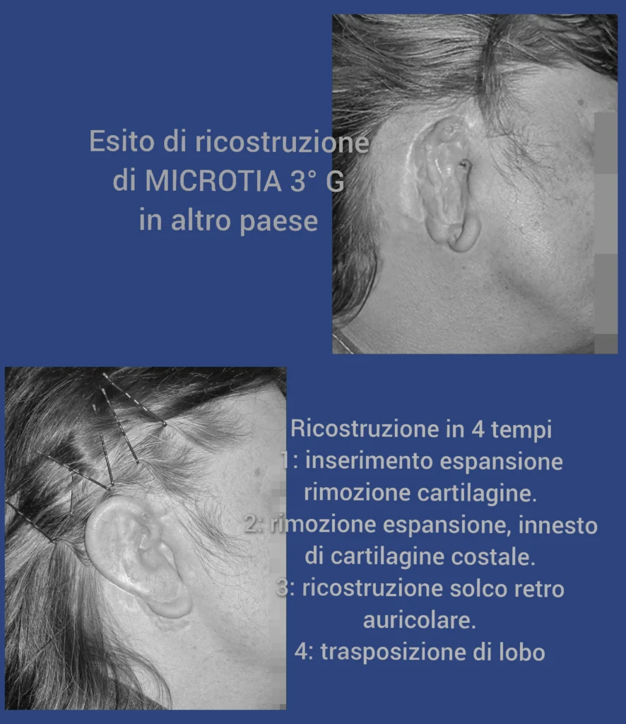 Otoplastica dott. Di Mascio | Microtia - Ricostruzione auricolare totale con cartilagine costale - Caso 11
