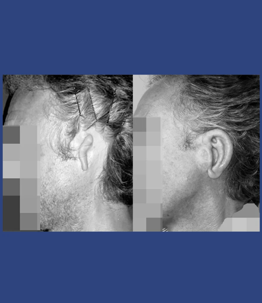 Otoplastica dott. Di Mascio | Microtia - Ricostruzione totale orecchie con cartilagine costale - Caso 4