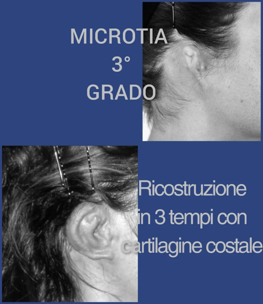 Otoplastica dott. Di Mascio | Microtia - Ricostruzione totale orecchie con cartilagine costale - Caso 5