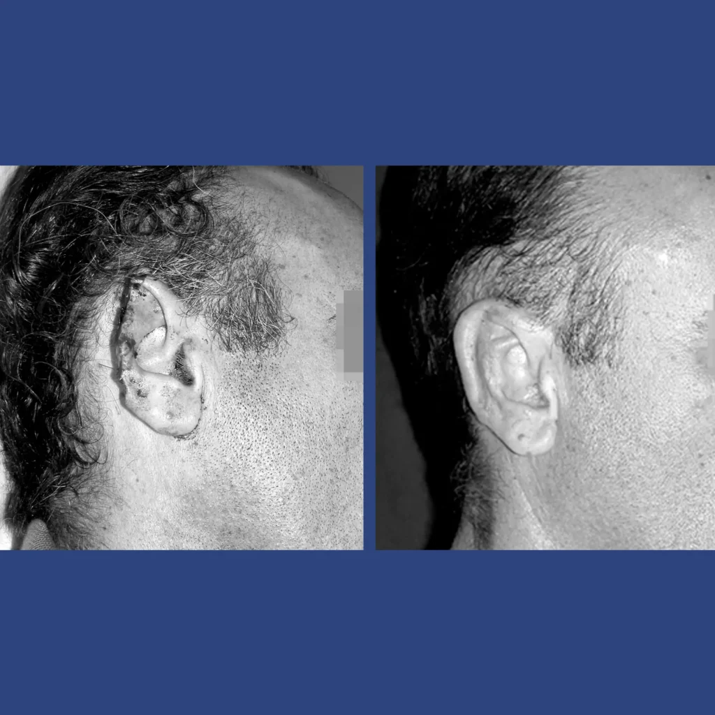Otoplastica dott. Di Mascio - Ricostruzione parziale Orecchio destro | Caso 5 - Foto 1