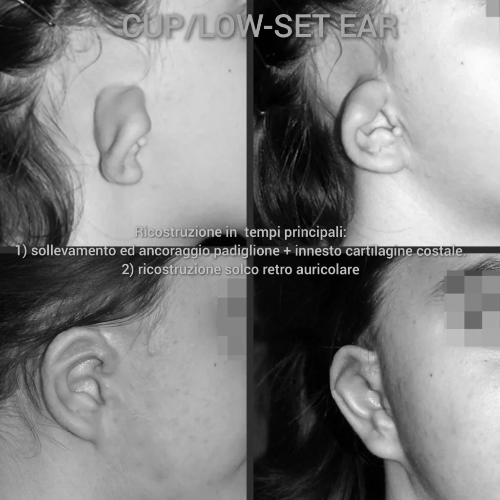 Otoplastica dott. Di Mascio - Ricostruzione parziale Orecchio destro | Caso 8 - Foto 1