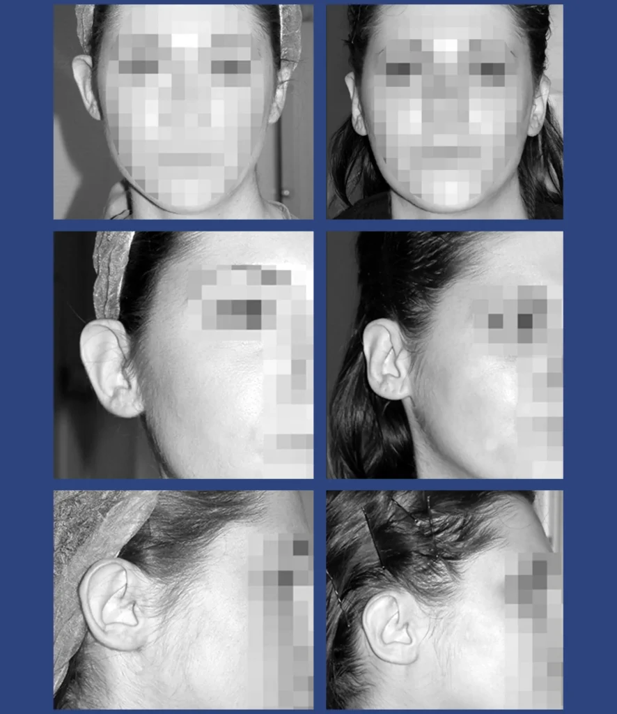 dott. Di Mascio - Otoplastica monolaterale | Caso 11 - Foto 1