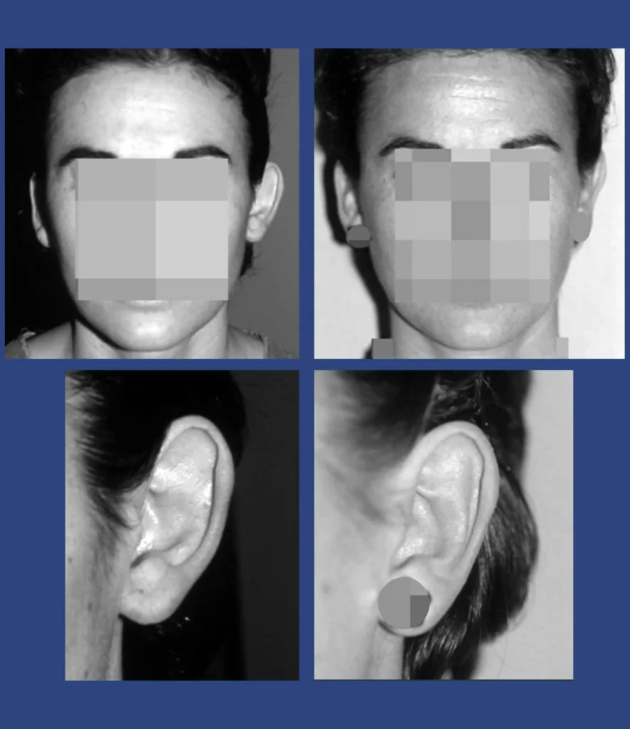 dott. Di Mascio - Otoplastica monolaterale | Caso 14 - Foto 1