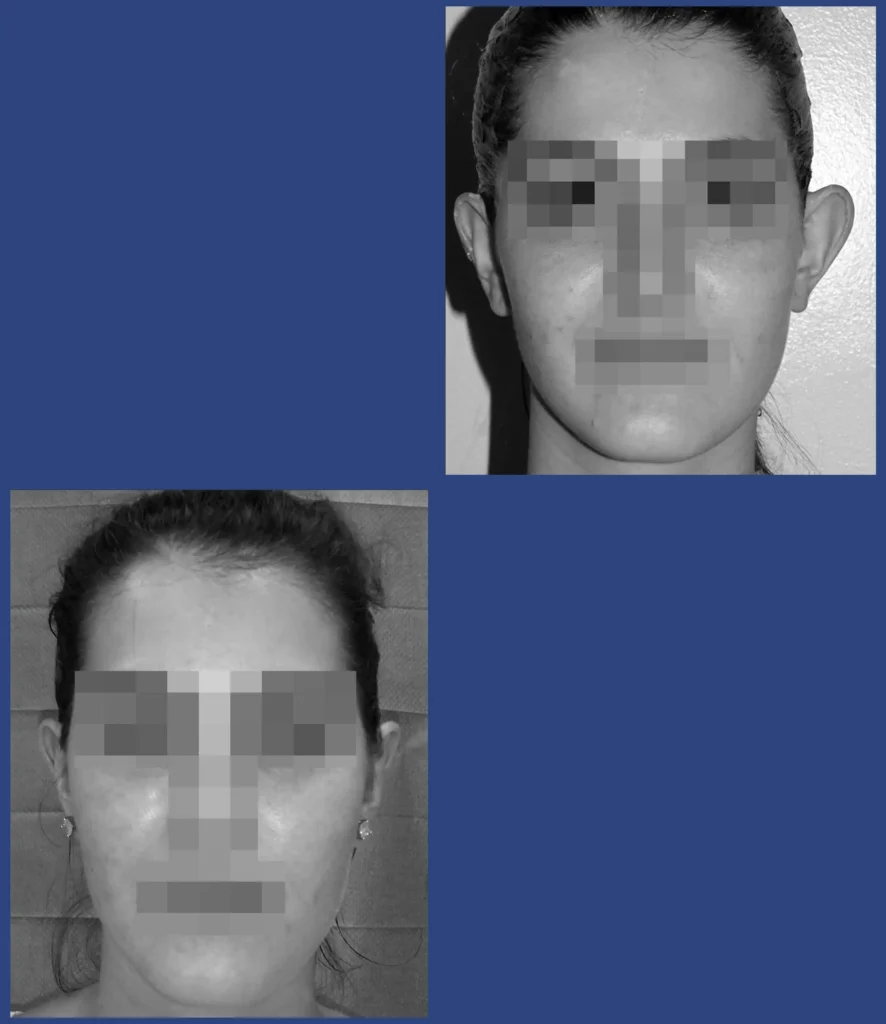 dott. Di Mascio - Otoplastica monolaterale | Caso 1 - Foto 2