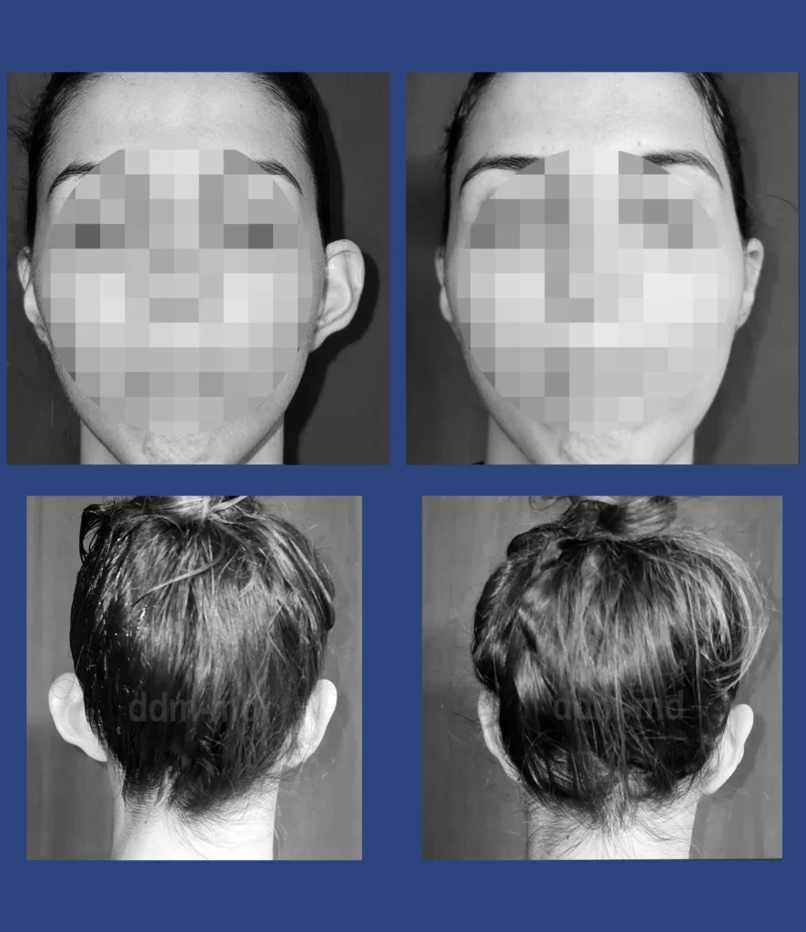 dott. Di Mascio - Otoplastica monolaterale | Caso 5 - Foto 1