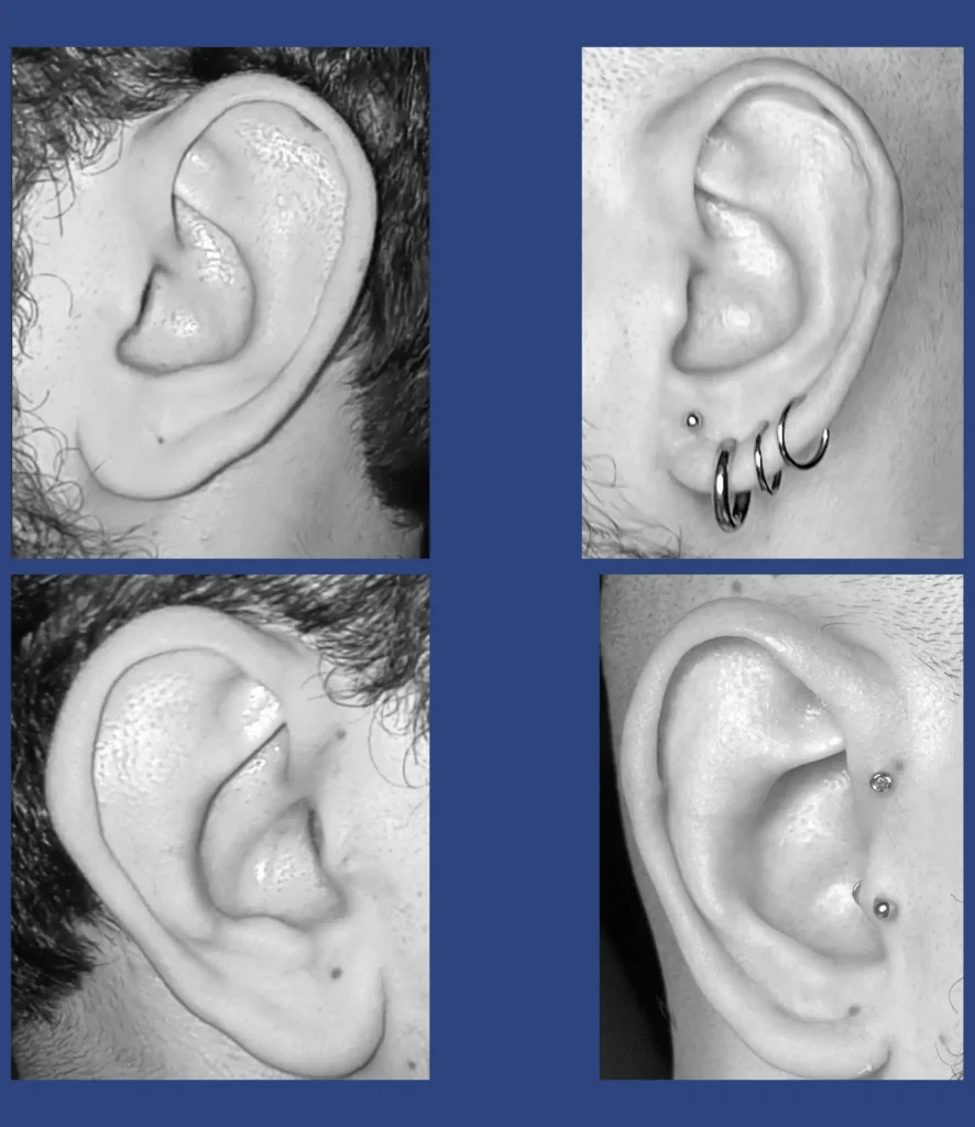 Otoplastica dott. Di Mascio - Riduzione Padiglioni auricolari | Caso 11 - Foto 1