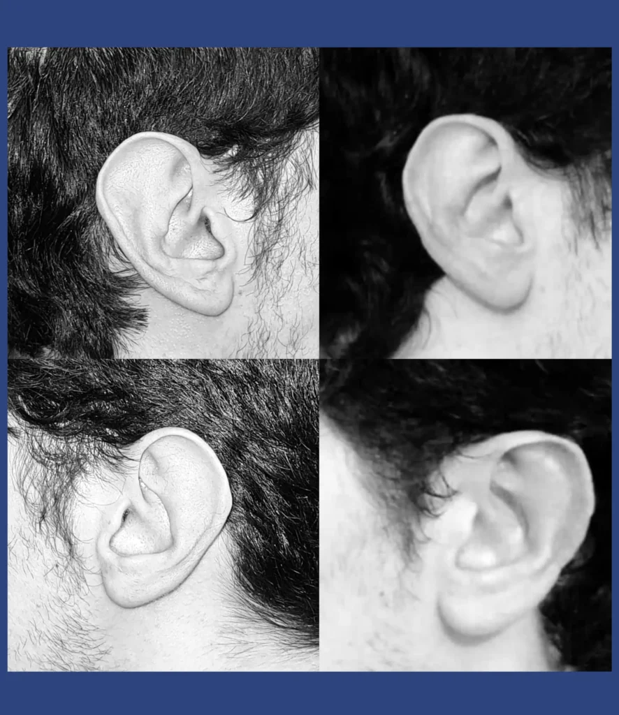 Otoplastica dott. Di Mascio - Riduzione Padiglioni auricolari | Caso 12 - Foto 1