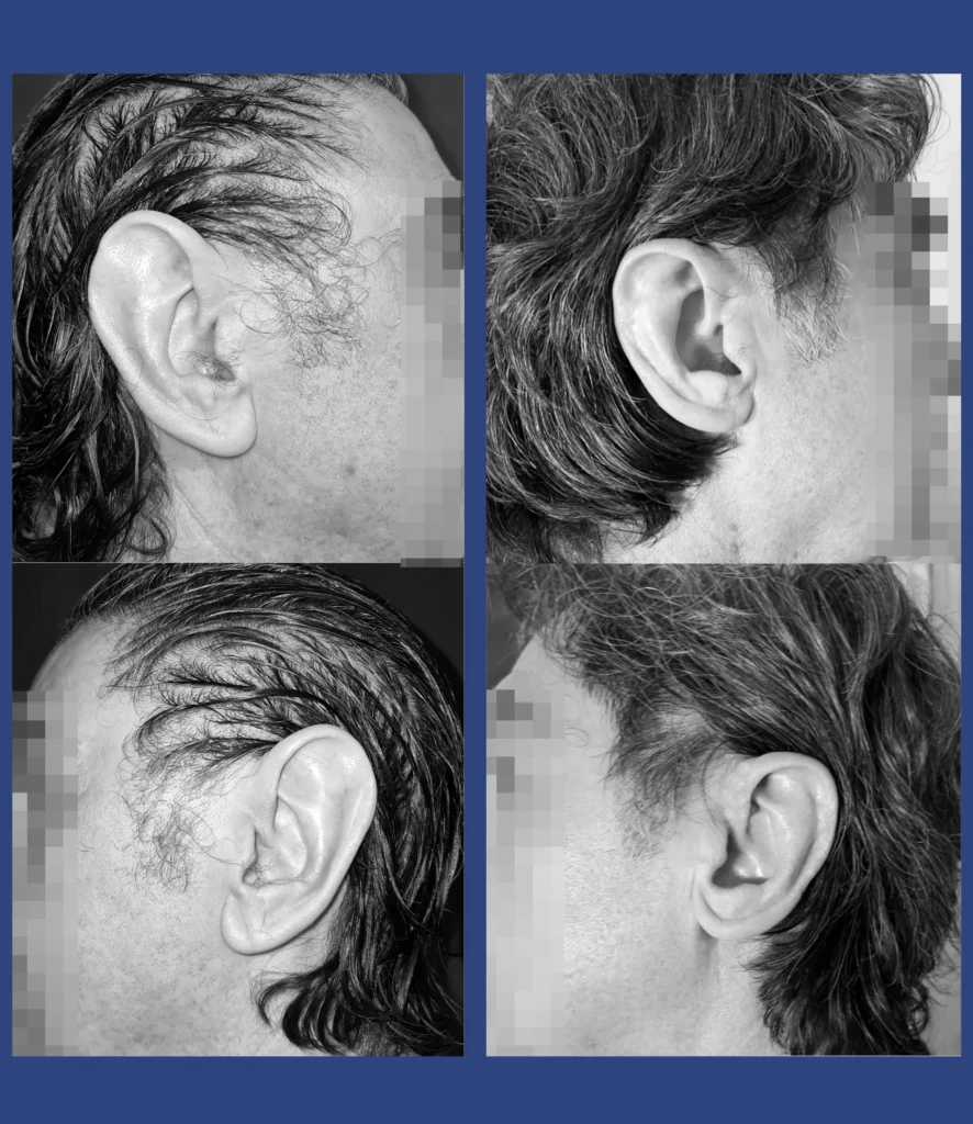 Otoplastica dott. Di Mascio - Riduzione Padiglioni auricolari | Caso 13 - Foto 1