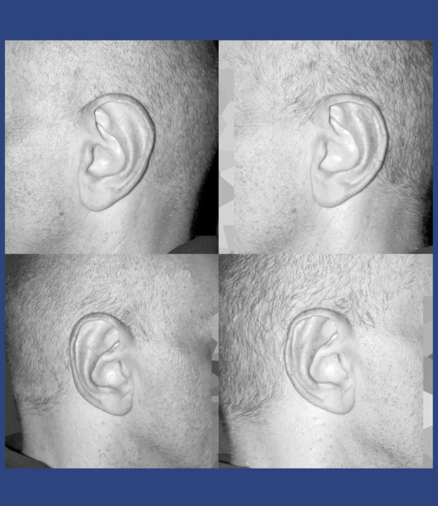 Otoplastica dott. Di Mascio - Riduzione Padiglioni auricolari | Caso 3 - Foto 1