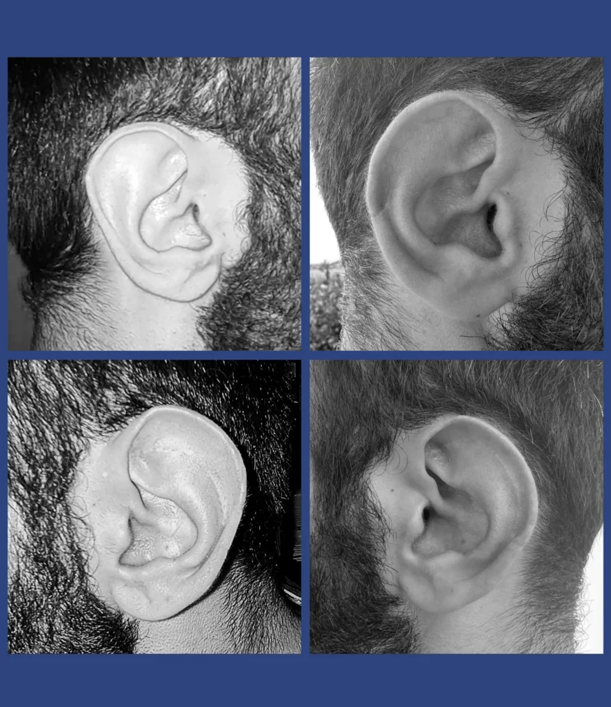 Otoplastica dott. Di Mascio - Riduzione Padiglioni auricolari | Caso 4 - Foto 1