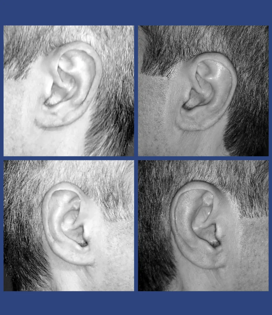 Otoplastica dott. Di Mascio - Riduzione Padiglioni auricolari | Caso 7 - Foto 1