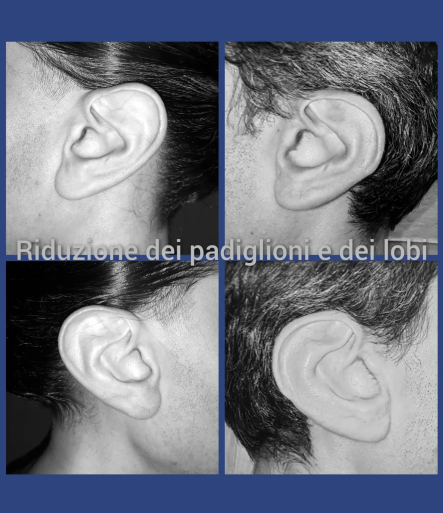 Otoplastica dott. Di Mascio - Riduzione Padiglioni auricolari e Lobi | Caso 8 - Foto 1