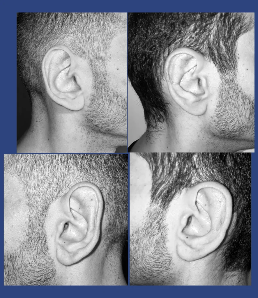 Otoplastica dott. Di Mascio - Riduzione Padiglioni auricolari | Caso 9 - Foto 1